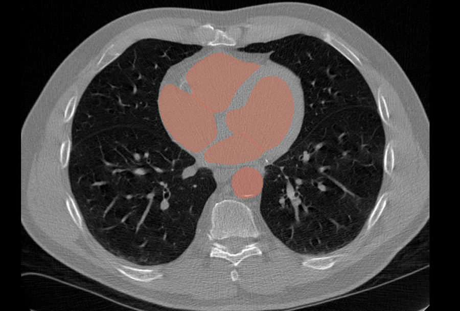 Heart & aorta segmented — illustrative CardioSight pipeline step