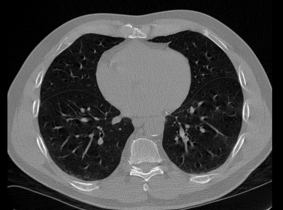 Existing chest CT — illustrative CardioSight pipeline step